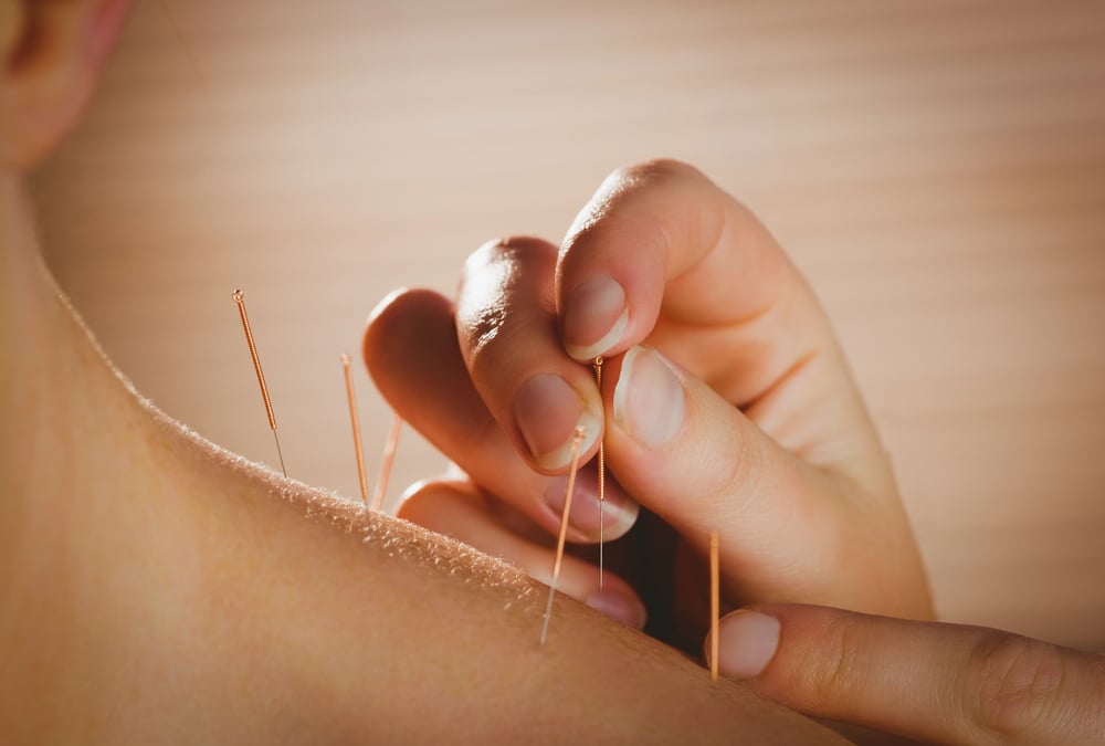 PTSD and acupuncture